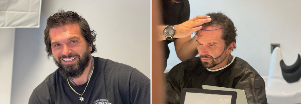 באנר השתלת זקן