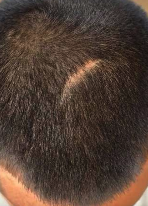 צלקות וכויות