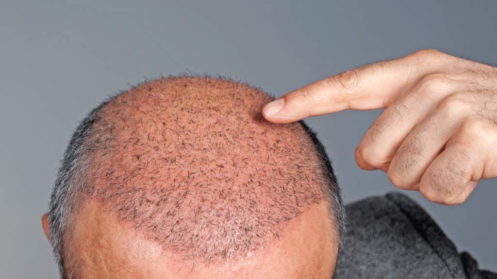 5 דברים שיש להימנע מהם לאחר השתלות שיער