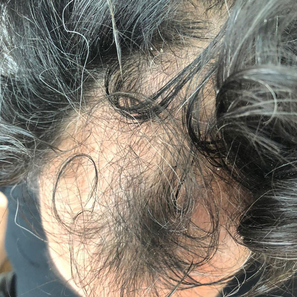 Greffe de cheveux en Turquie